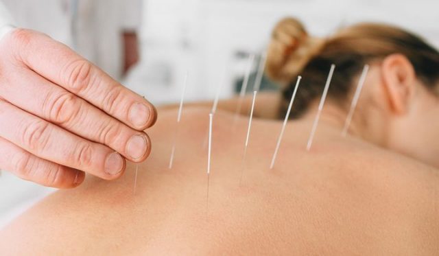 Comment se déroule une séance d’acupuncture à Lausanne ?
